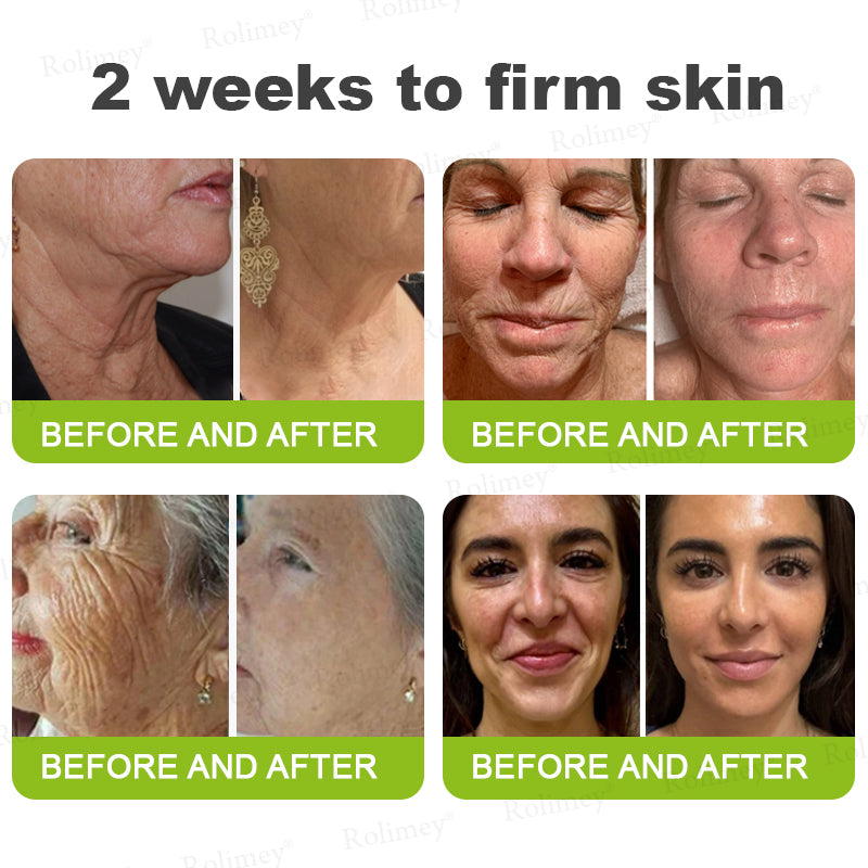 Rolimey® Botox & Vita-A Retinol Shot Wrinkle-Lift Tightening cream - Last Day Promotion 70% OFF