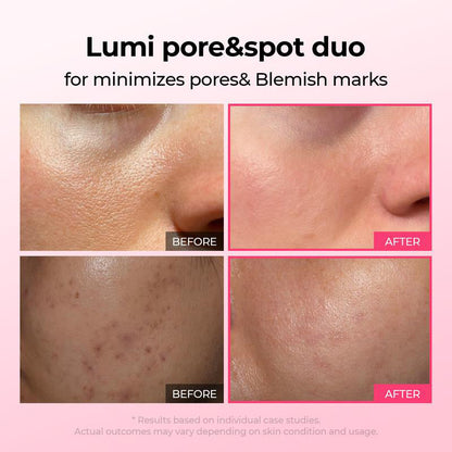 Shrinks Pores & Fades Blemish Marks
