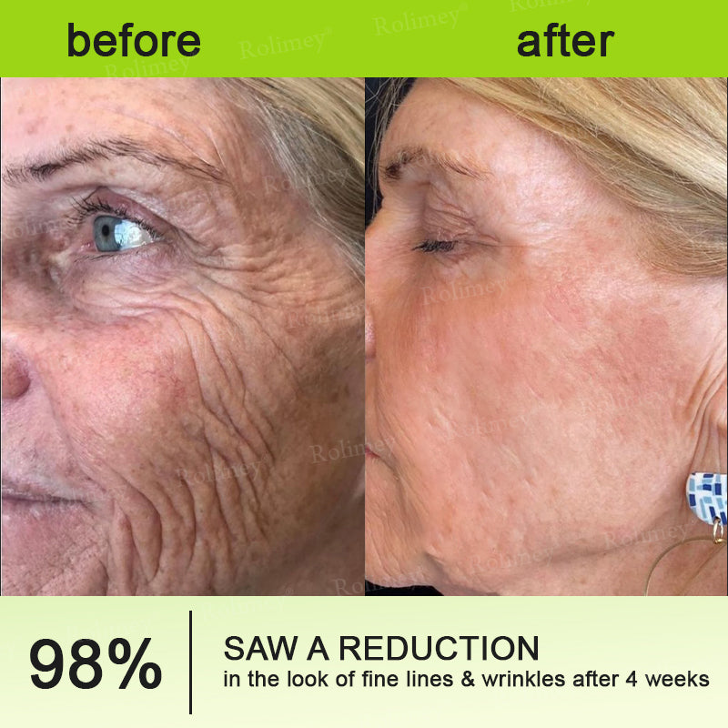 Rolimey® Botox & Vita-A Retinol Shot Wrinkle-Lift Tightening cream - Last Day Promotion 70% OFF