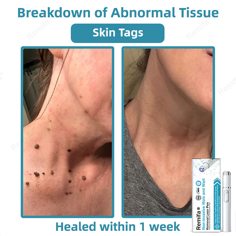 REMIFA® N𝐨n-inv𝐚siv𝐞 𝐌𝐨l𝐞 and W𝐚rt 𝐑𝐞m𝐨v𝐚l L𝐚s𝐞r 𝐏𝐞n 𝐏r𝐨m𝐚x