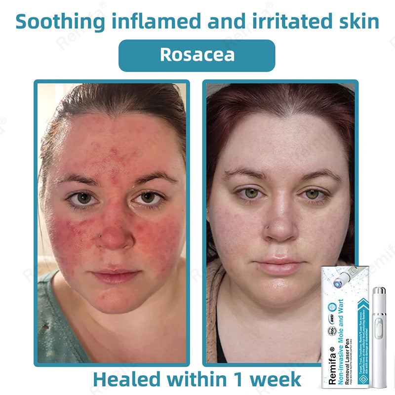 REMIFA® N𝐨n-inv𝐚siv𝐞 𝐌𝐨l𝐞 and W𝐚rt 𝐑𝐞m𝐨v𝐚l L𝐚s𝐞r 𝐏𝐞n 𝐏r𝐨m𝐚x