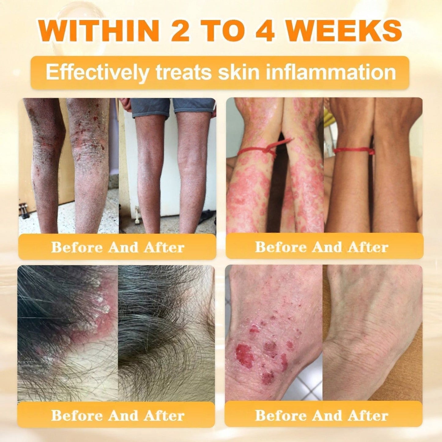 FDA Approved|Rolimey® Bee Venom Skin Restoration Cream (Anti-aging, Hydrating, Skin Repair, Even Tone, Acne and Dark Spot Treatment, Wart and Mole Removal, Psoriasis Relief)