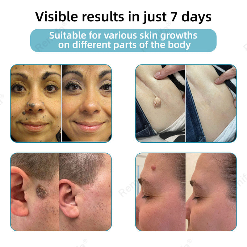 REMIFA® N𝐨n-inv𝐚siv𝐞 𝐌𝐨l𝐞 and W𝐚rt 𝐑𝐞m𝐨v𝐚l L𝐚s𝐞r 𝐏𝐞n 𝐏r𝐨m𝐚x
