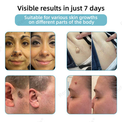 REMIFA® N𝐨n-inv𝐚siv𝐞 𝐌𝐨l𝐞 and W𝐚rt 𝐑𝐞m𝐨v𝐚l L𝐚s𝐞r 𝐏𝐞n 𝐏r𝐨m𝐚x