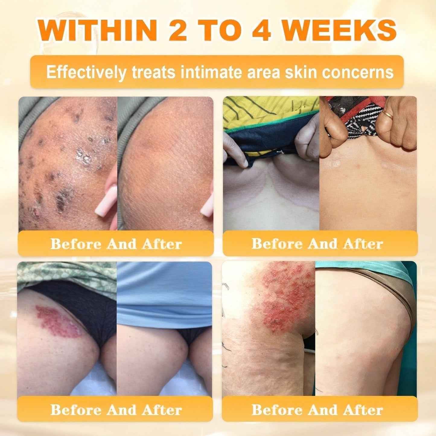 FDA Approved|Rolimey® Bee Venom Skin Restoration Cream (Anti-aging, Hydrating, Skin Repair, Even Tone, Acne and Dark Spot Treatment, Wart and Mole Removal, Psoriasis Relief)