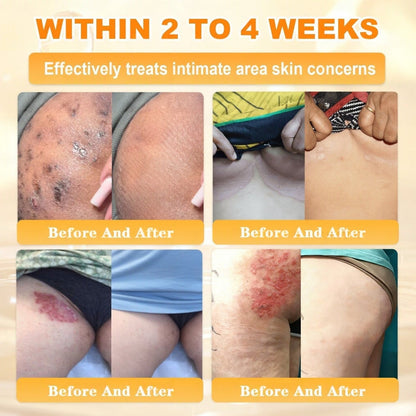 FDA Approved|Rolimey® Bee Venom Skin Restoration Cream (Anti-aging, Hydrating, Skin Repair, Even Tone, Acne and Dark Spot Treatment, Wart and Mole Removal, Psoriasis Relief)