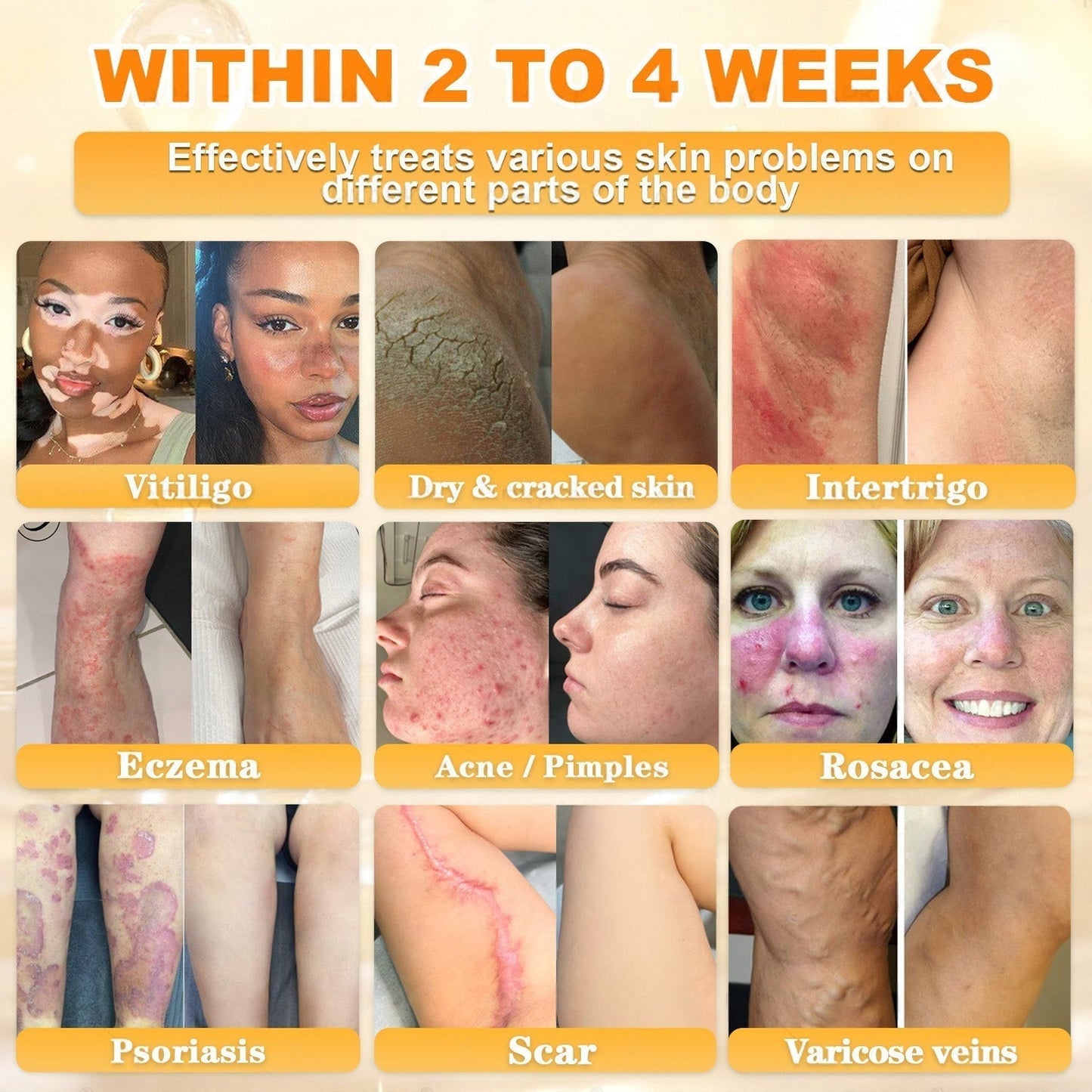 FDA Approved|Rolimey® Bee Venom Skin Restoration Cream (Anti-aging, Hydrating, Skin Repair, Even Tone, Acne and Dark Spot Treatment, Wart and Mole Removal, Psoriasis Relief)