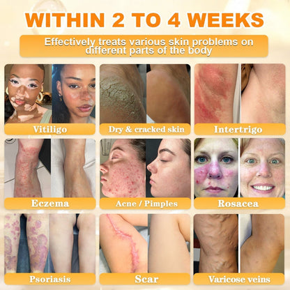 FDA Approved|Rolimey® Bee Venom Skin Restoration Cream (Anti-aging, Hydrating, Skin Repair, Even Tone, Acne and Dark Spot Treatment, Wart and Mole Removal, Psoriasis Relief)