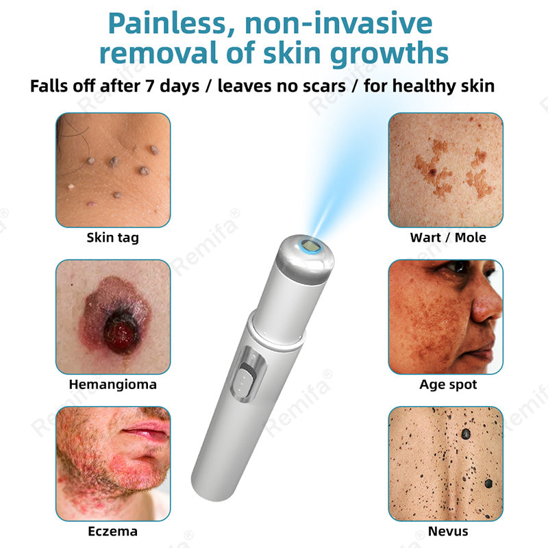 REMIFA® N𝐨n-inv𝐚siv𝐞 𝐌𝐨l𝐞 and W𝐚rt 𝐑𝐞m𝐨v𝐚l L𝐚s𝐞r 𝐏𝐞n 𝐏r𝐨m𝐚x