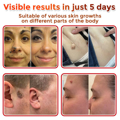 ✔GFOUK® MicroNeedle Botanic Skin Tag Removal Patch 🇺🇸 Made in the USA