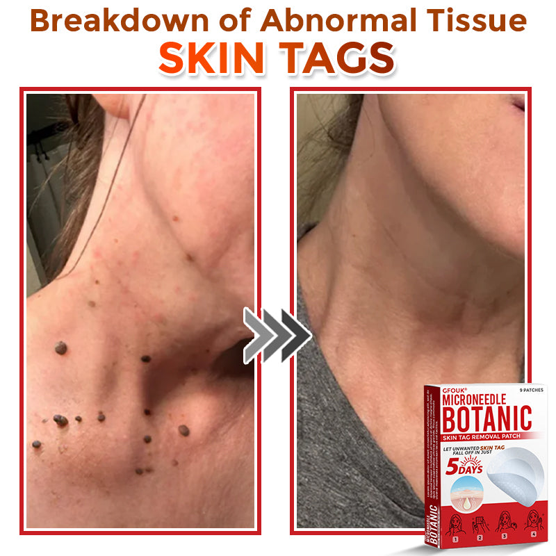 ✔GFOUK® MicroNeedle Botanic Skin Tag Removal Patch 🇺🇸 Made in the USA