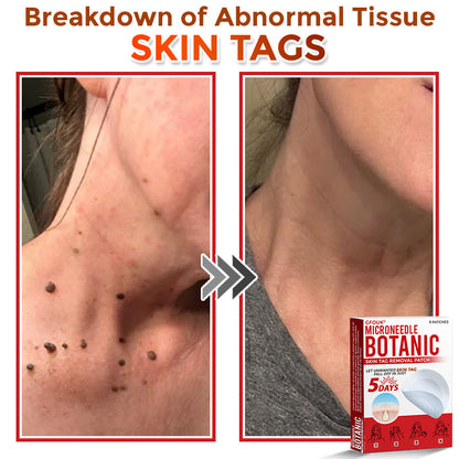✔GFOUK® MicroNeedle Botanic Skin Tag Removal Patch 🇺🇸 Made in the USA