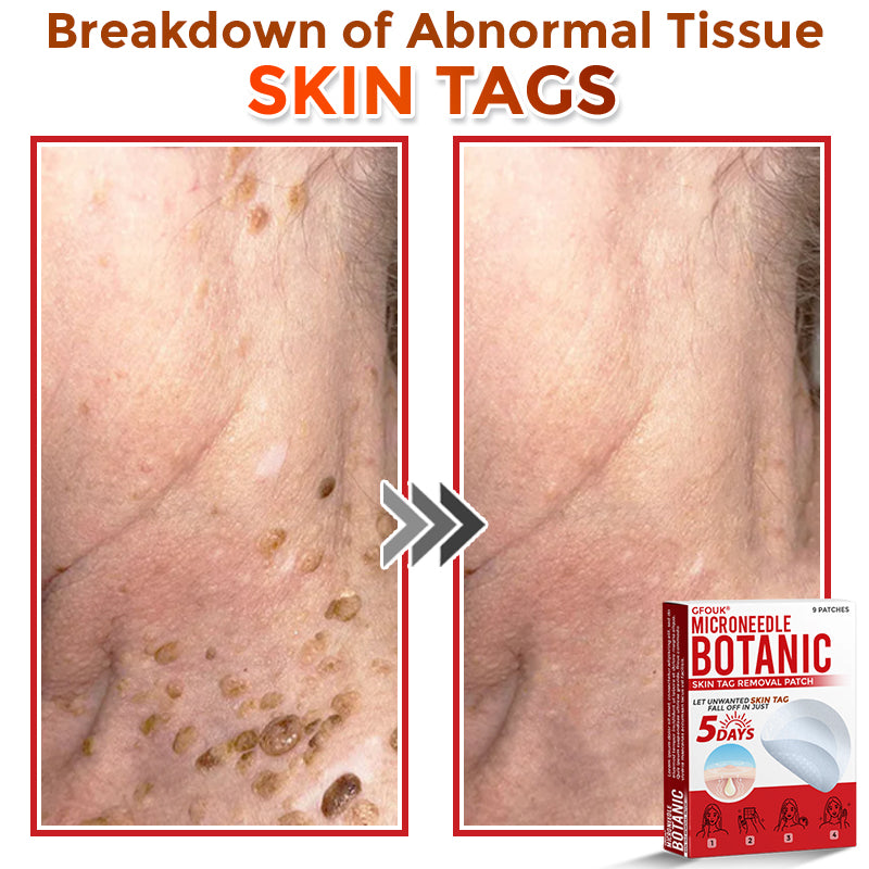 ✔GFOUK® MicroNeedle Botanic Skin Tag Removal Patch 🇺🇸 Made in the USA