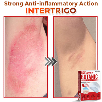 ✔GFOUK® MicroNeedle Botanic Skin Tag Removal Patch 🇺🇸 Made in the USA