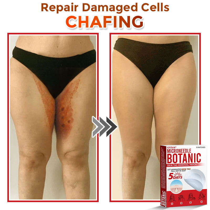 ✔GFOUK® MicroNeedle Botanic Skin Tag Removal Patch 🇺🇸 Made in the USA