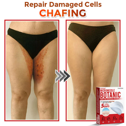 ✔GFOUK® MicroNeedle Botanic Skin Tag Removal Patch 🇺🇸 Made in the USA