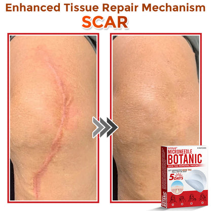 ✔GFOUK® MicroNeedle Botanic Skin Tag Removal Patch 🇺🇸 Made in the USA