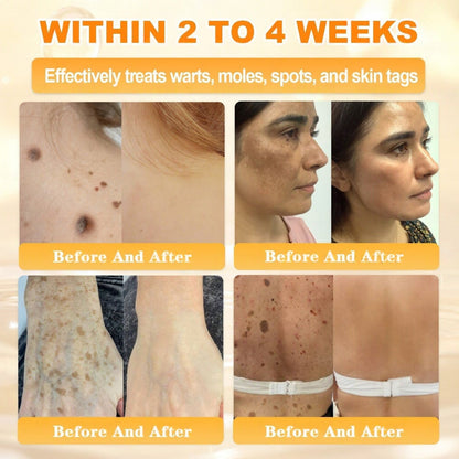 FDA Approved|Rolimey® Bee Venom Skin Restoration Cream (Anti-aging, Hydrating, Skin Repair, Even Tone, Acne and Dark Spot Treatment, Wart and Mole Removal, Psoriasis Relief)